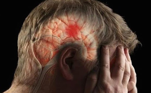 Conozca los síntomas que pueden advertir de un derrame cerebral