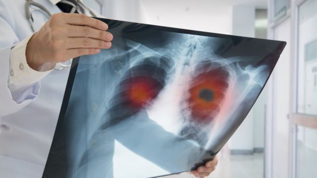 Especialistas explican: ¿Cómo detectar y prevenir cáncer de pulmón tempranamente?