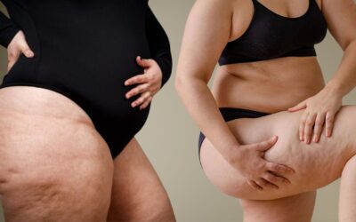 No estás gorda, tienes lipedema: lo que millones de mujeres nunca supieron